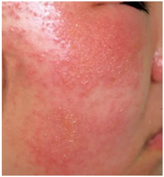 急性アレルギー性接触皮膚炎(ウルシ)