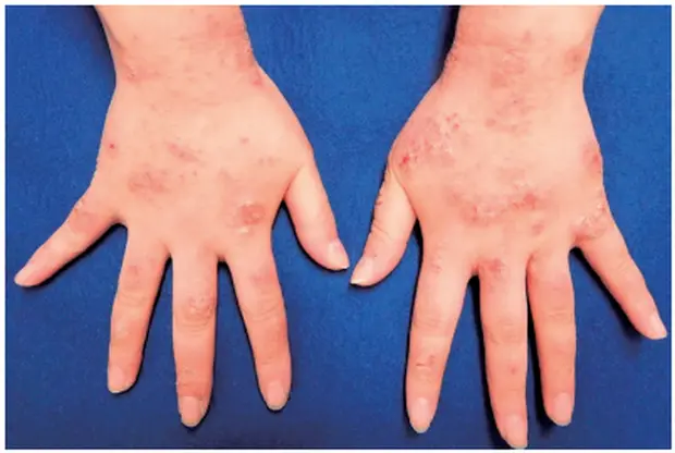 貨幣状型手湿疹