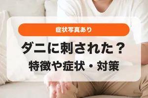 【発疹・湿疹など症状写真あり】ダニに刺された跡の特徴や症状・対策・あせもとの見分け方