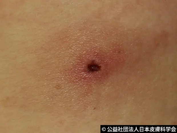 ダニに刺された